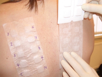 Прикрепление пластыря с нанесёнными аллергенами на кожу пациента